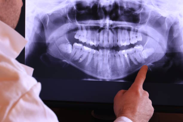 Best Emergency Tooth Extraction in Albany, MN